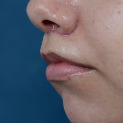 Lip Lift Before & After Gallery - Patient 8341617 - Image 4