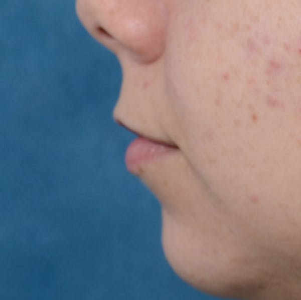 Lip Lift Before & After Gallery - Patient 8341617 - Image 5