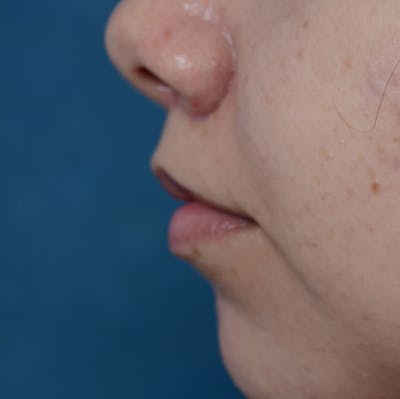Lip Lift Before & After Gallery - Patient 8341617 - Image 6