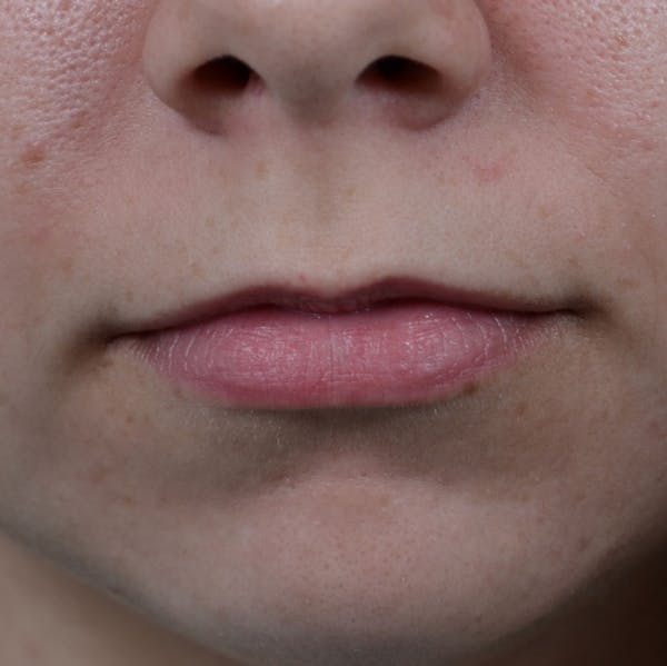 Lip Lift Before & After Gallery - Patient 8341617 - Image 1