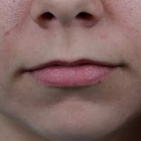 Lip Lift Before & After Gallery - Patient 8341617 - Image 1