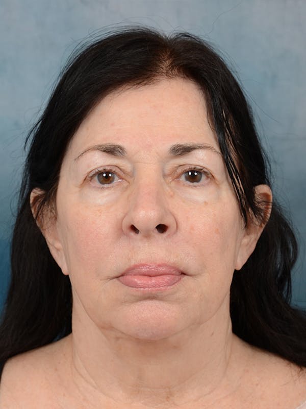 Deep Plane Facelift Before & After Gallery - Patient 6158554 - Image 3