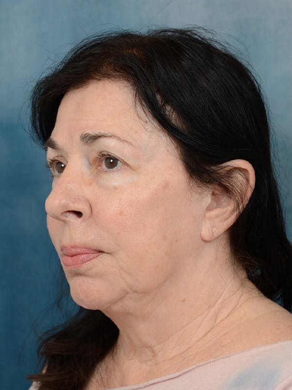 Deep Plane Facelift Before & After Gallery - Patient 6158554 - Image 1