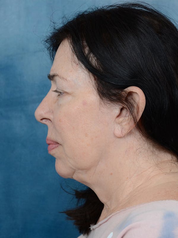 Deep Plane Facelift Before & After Gallery - Patient 6158554 - Image 5