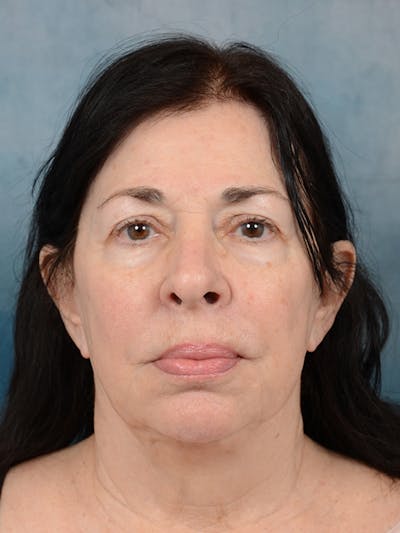 Fat Transfer Before & After Gallery - Patient 6279736 - Image 1