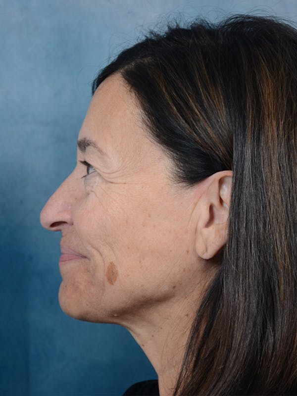Laser Skin Resurfacing Before & After Gallery - Patient 5923302 - Image 5