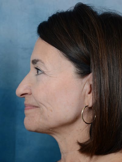 Laser Skin Resurfacing Before & After Gallery - Patient 5923302 - Image 6