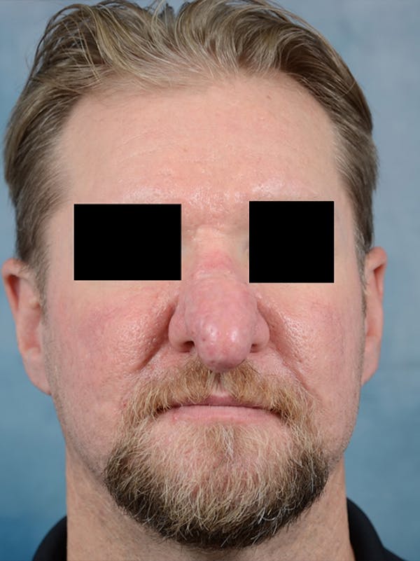 Rhinophyma Before & After Gallery - Patient 9980611 - Image 1