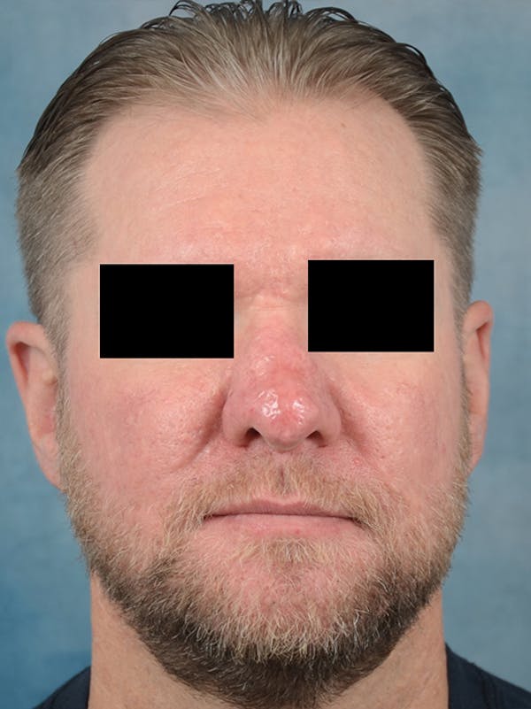 Rhinophyma Before & After Gallery - Patient 9980611 - Image 2