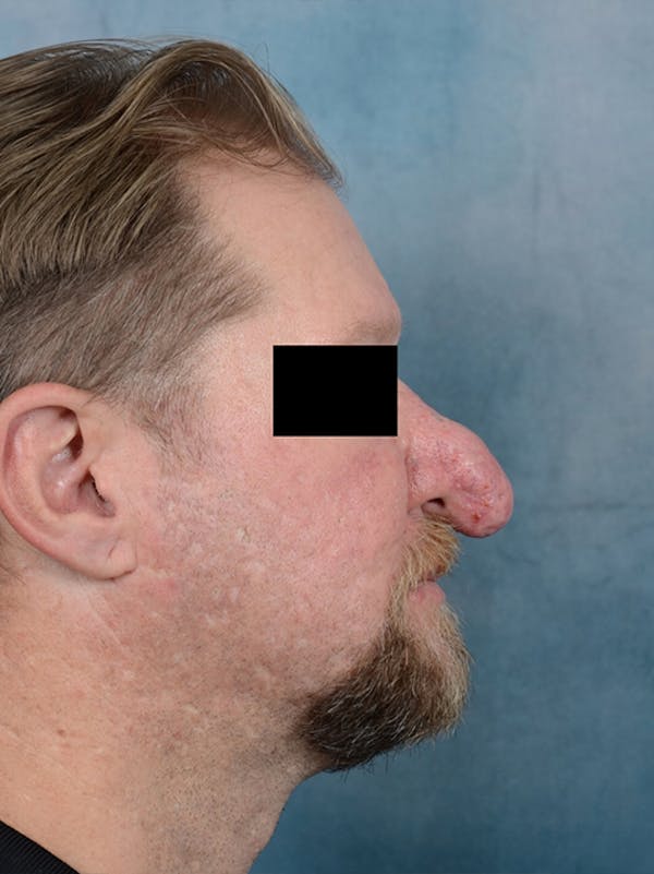 Rhinophyma Gallery - Patient 9980611 - Image 3