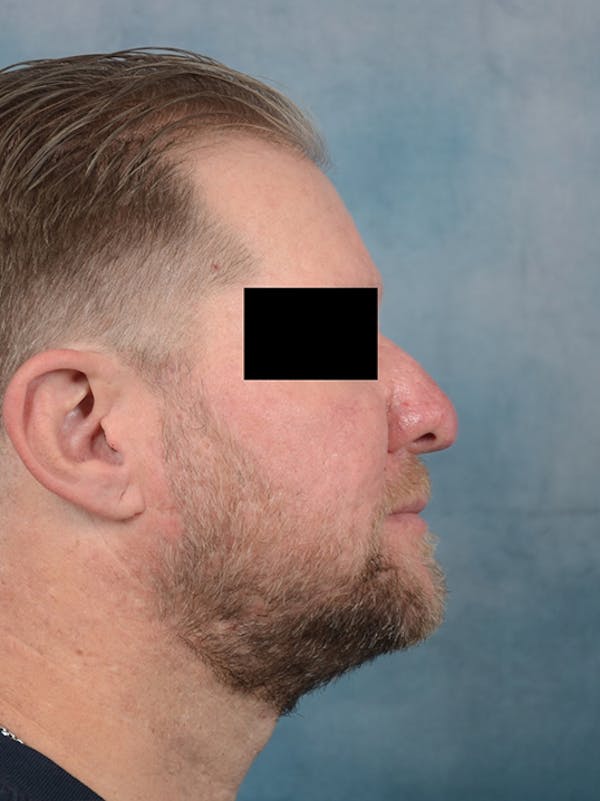 Rhinophyma Before & After Gallery - Patient 9980611 - Image 4