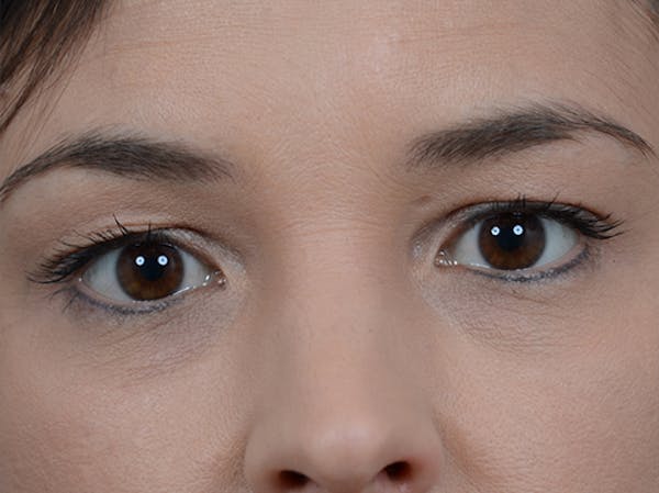 Eyelid Lift Before & After Gallery - Patient 10945496 - Image 1