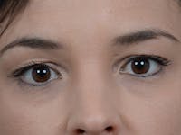 Eyelid Lift Before & After Gallery - Patient 10945496 - Image 1