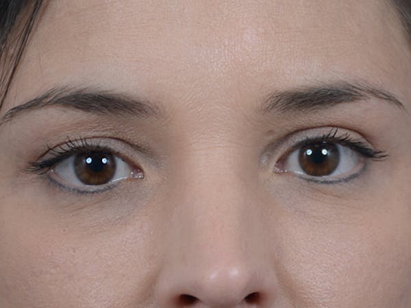 Eyelid Lift Before & After Gallery - Patient 10945496 - Image 2