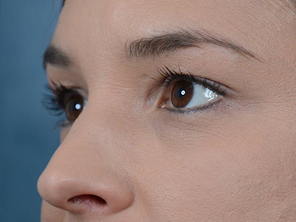Eyelid Lift Before & After Gallery - Patient 10945496 - Image 3
