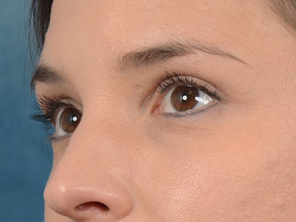 Eyelid Lift Before & After Gallery - Patient 10945496 - Image 4