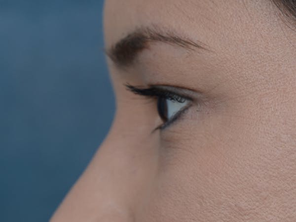 Eyelid Lift Before & After Gallery - Patient 10945496 - Image 5