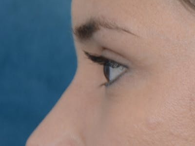 Eyelid Lift Before & After Gallery - Patient 10945496 - Image 6