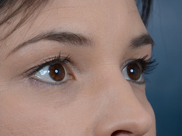 Eyelid Lift Before & After Gallery - Patient 10945496 - Image 7