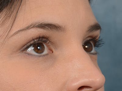 Eyelid Lift Before & After Gallery - Patient 10945496 - Image 8