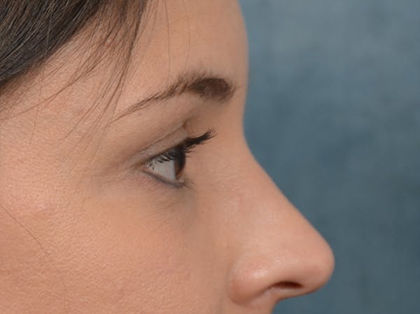 Eyelid Lift Before & After Gallery - Patient 10945496 - Image 10