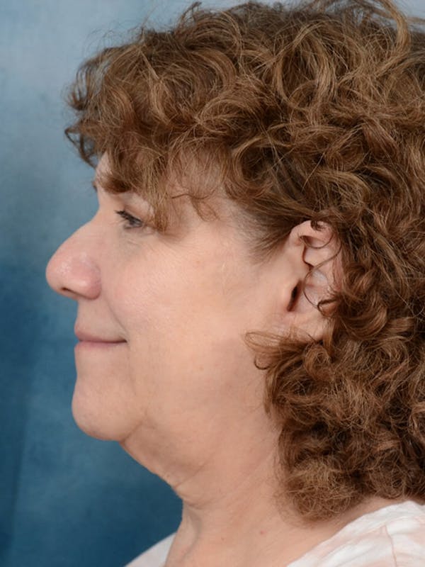 Deep Plane Facelift Before & After Gallery - Patient 10948747 - Image 5