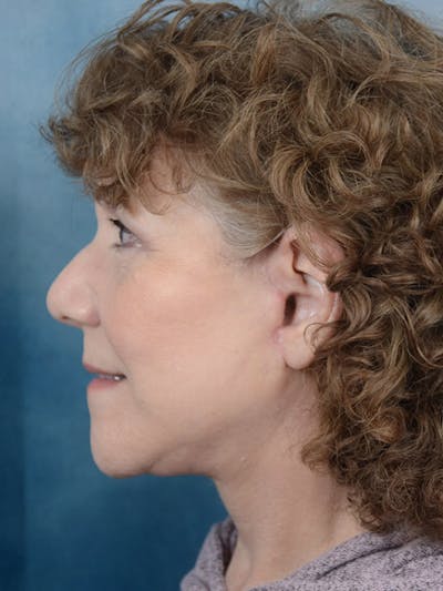 Deep Plane Facelift Before & After Gallery - Patient 10948747 - Image 6