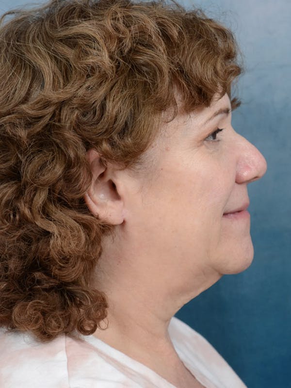 Deep Plane Facelift Before & After Gallery - Patient 10948747 - Image 9