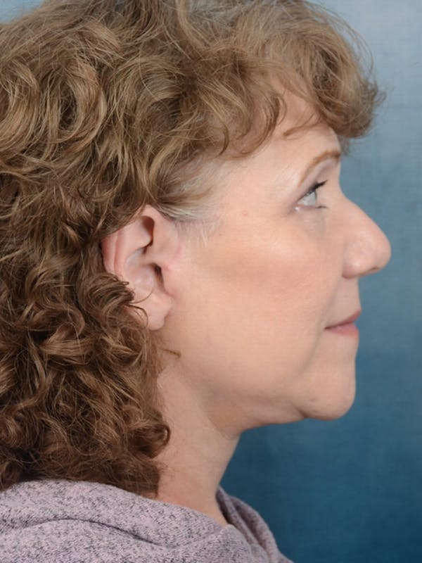 Deep Plane Facelift Before & After Gallery - Patient 10948747 - Image 10