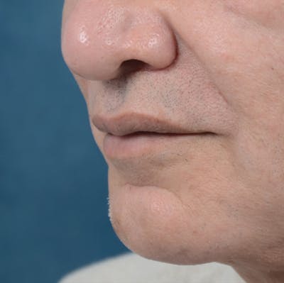 Lip Lift Before & After Gallery - Patient 12608394 - Image 2