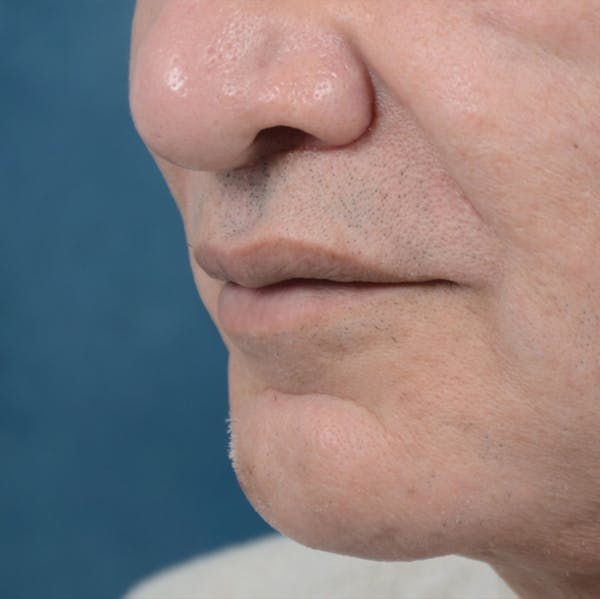 Lip Lift Before & After Gallery - Patient 12608394 - Image 2