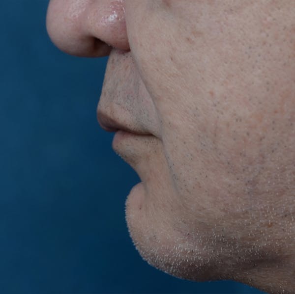 Lip Lift Before & After Gallery - Patient 12608394 - Image 3