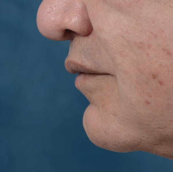 Lip Lift Before & After Gallery - Patient 12608394 - Image 4