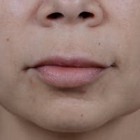 Lip Lift Before & After Gallery - Patient 12745272 - Image 1