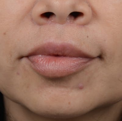 Lip Lift Before & After Gallery - Patient 12745272 - Image 2