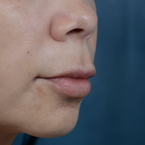 Lip Lift Before & After Gallery - Patient 12745272 - Image 3