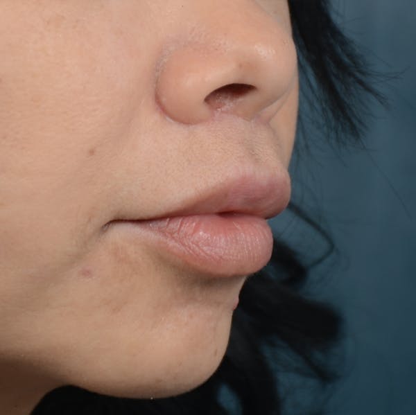 Lip Lift Before & After Gallery - Patient 12745272 - Image 4