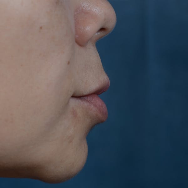 Lip Lift Before & After Gallery - Patient 12745272 - Image 5