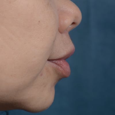 Lip Lift Before & After Gallery - Patient 12745272 - Image 6