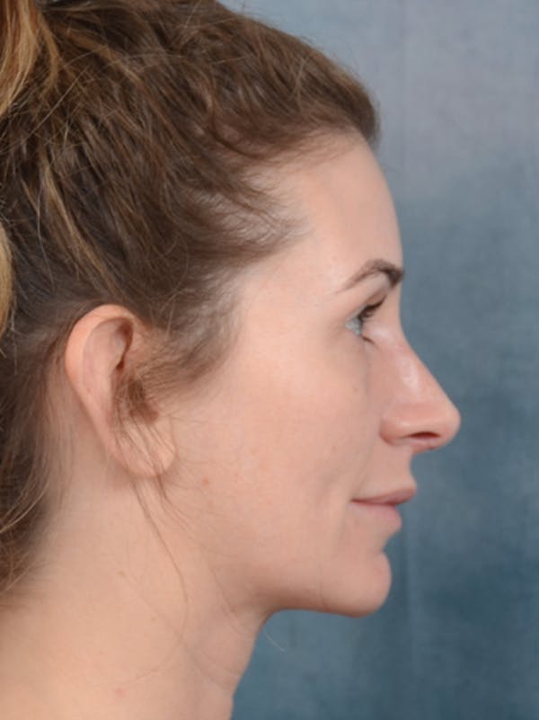 Rhinoplasty Before & After Gallery - Patient 6279838 - Image 10