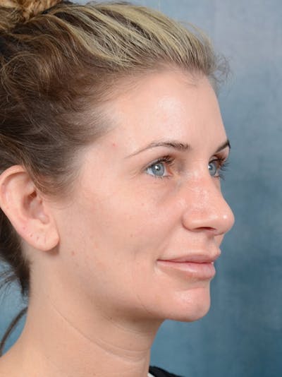 Rhinoplasty Before & After Gallery - Patient 6279838 - Image 8