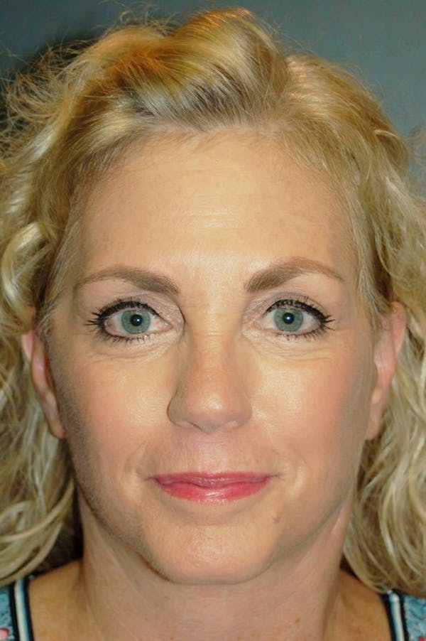 Deep Plane Facelift Before & After Gallery - Patient 4521009 - Image 4