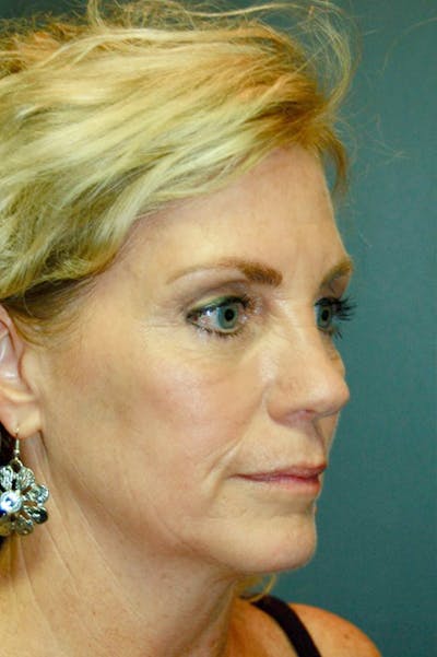 Deep Plane Facelift Before & After Gallery - Patient 4521009 - Image 1