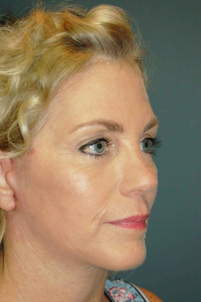 Deep Plane Facelift Before & After Gallery - Patient 4521009 - Image 2