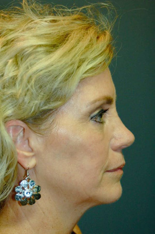 Deep Plane Facelift Before & After Gallery - Patient 4521009 - Image 5