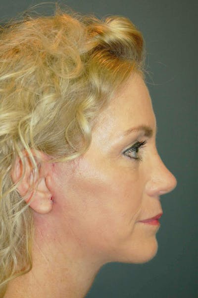 Deep Plane Facelift Before & After Gallery - Patient 4521009 - Image 6