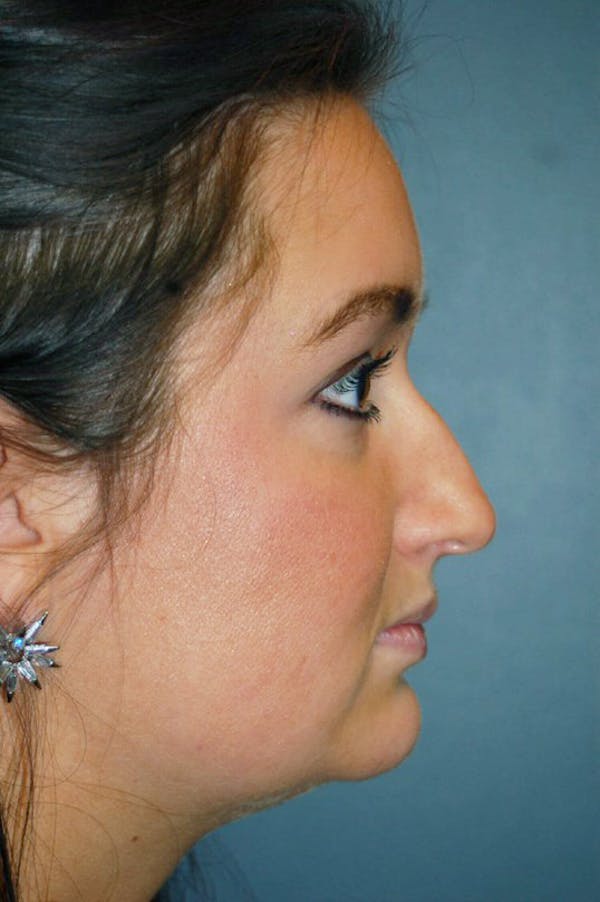 Rhinoplasty Before & After Gallery - Patient 4521037 - Image 3