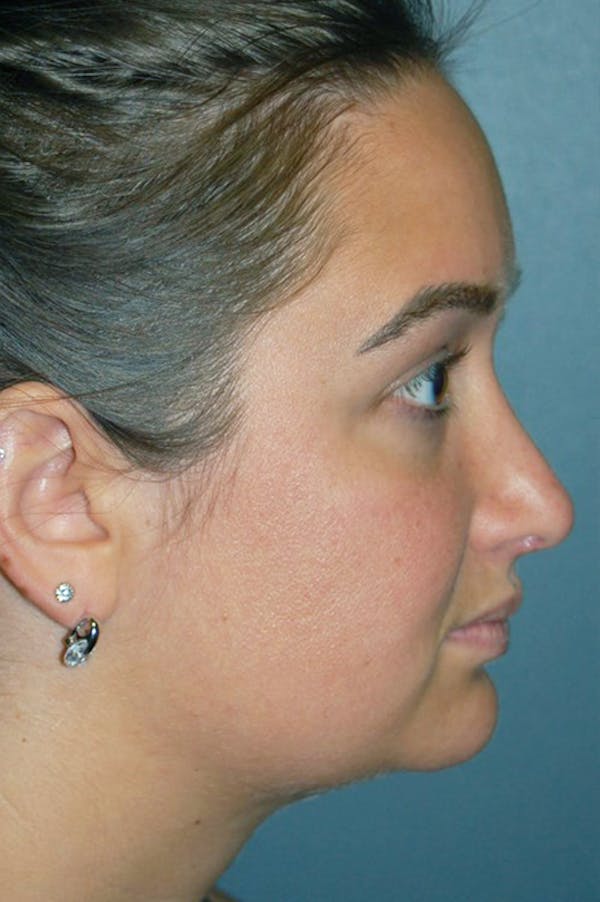 Rhinoplasty Before & After Gallery - Patient 4521037 - Image 4