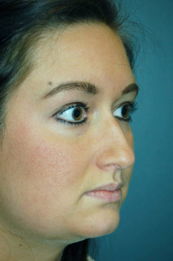 Rhinoplasty Before & After Gallery - Patient 4521037 - Image 5