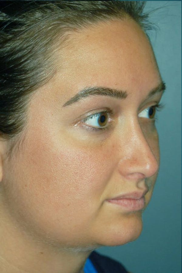 Rhinoplasty Before & After Gallery - Patient 4521037 - Image 6